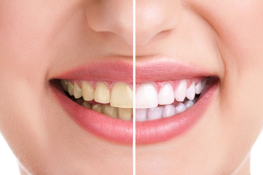 At-Home-Teeth-Whitening-vs-Professional-Teeth-Whitening