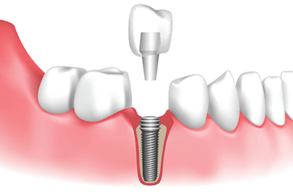 How-Much-Do-Dental-Implants-Cost