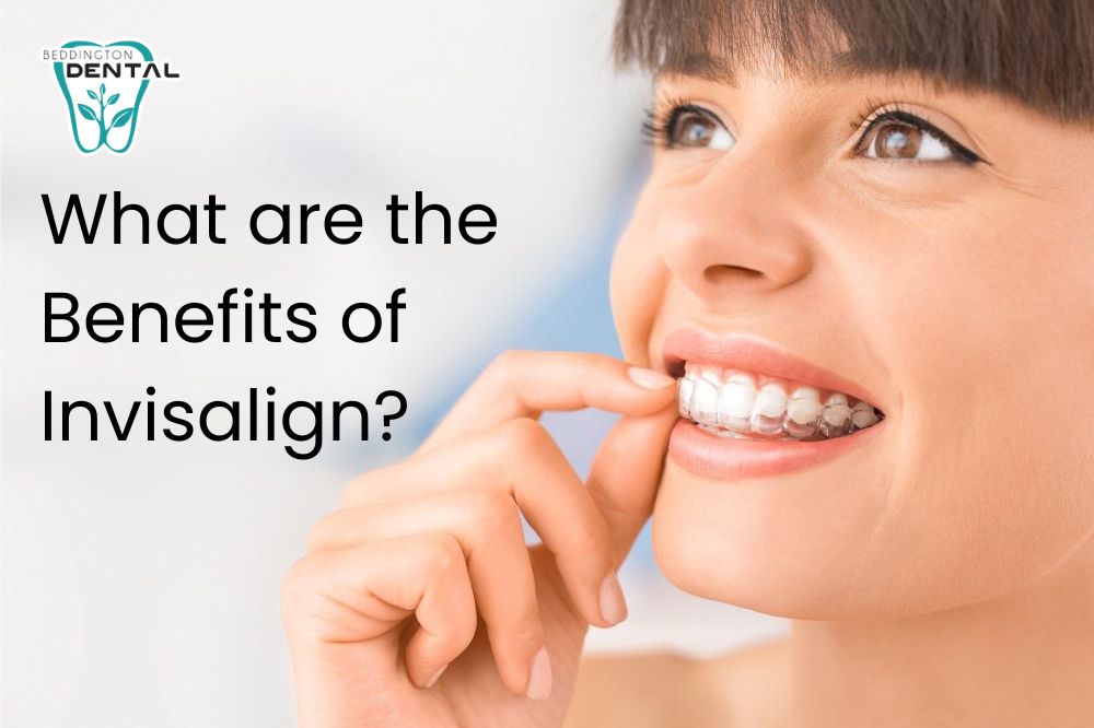 What are the Benefits of Invisalign?